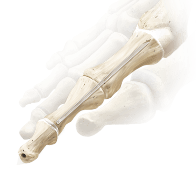 Interphalangeal Joint Fusion