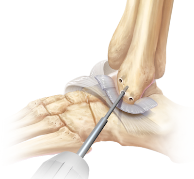 Lateral Ankle Instability