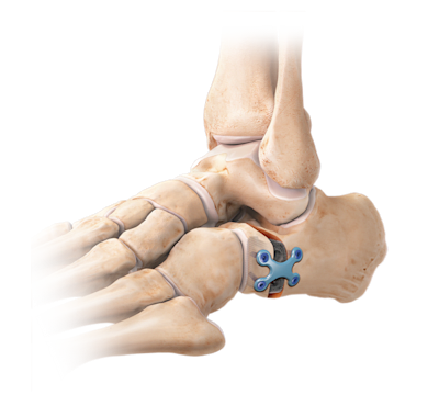 Alongamento da coluna lateral (osteotomia de Evans)