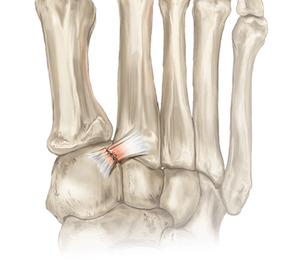 Dislocación de Lisfranc