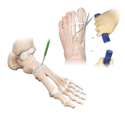 Fixierung einer Lisfranc-Verletzung