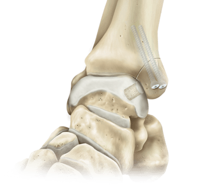 Medial Malleolus Osteotomy