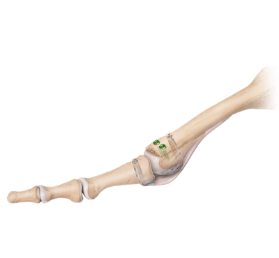 Osteotomia para encurtamento metatarsal