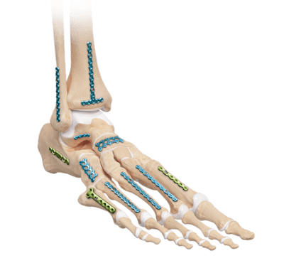 Mini Fragment Plating Fixation