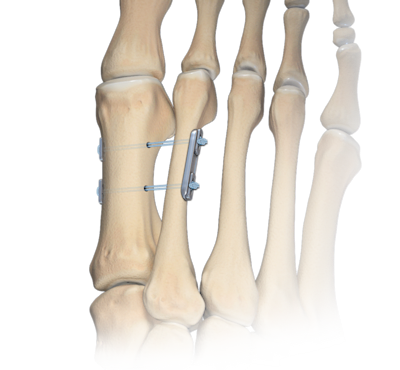 Mini-TightRope-Technik bei Hallux valgus