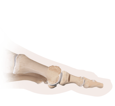 Osteotomia de Moberg