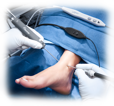 Nano Arthroscopy for Foot and Ankle