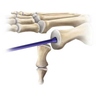 Aloenxerto osteocondral