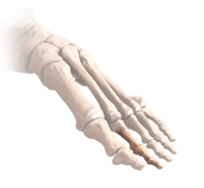 Proximal Interphalangeal Joint (PIP) Dart Implant