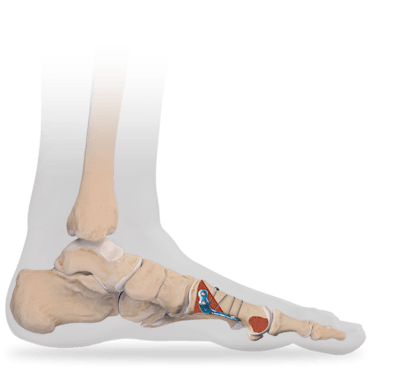 Proximal 1st Metatarsal Osteotomy 