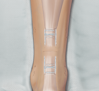 Perkutanes Achillessehnenrefixierungssystem (PARS)