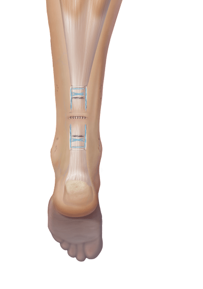 PARS Achilles Jig System