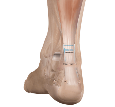 Sistema de implante Achilles Midsubstance SpeedBridge™