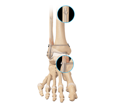 FibuLock<sup>®</sup> Fibular Nail