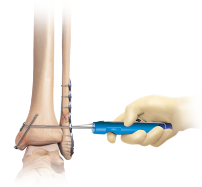 Ankle Fracture Management
 System