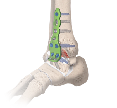 Ankle Fusion Plating