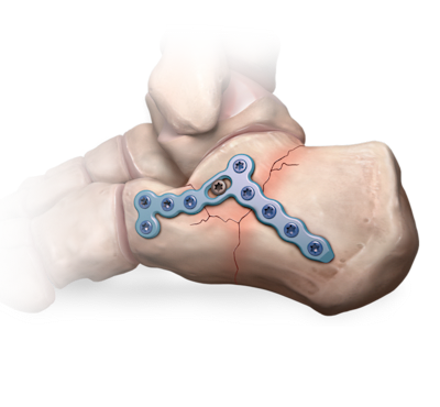 Sistema para fracturas del calcáneo