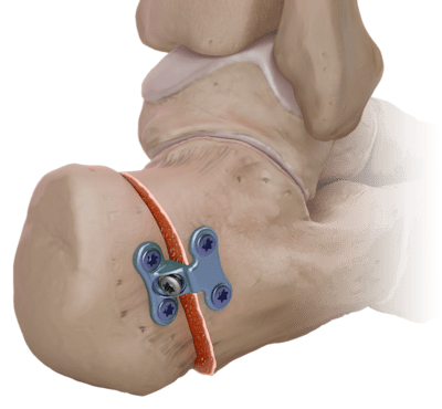 Calcaneus Step Plate