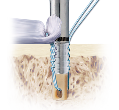 Knotless Suture Anchors