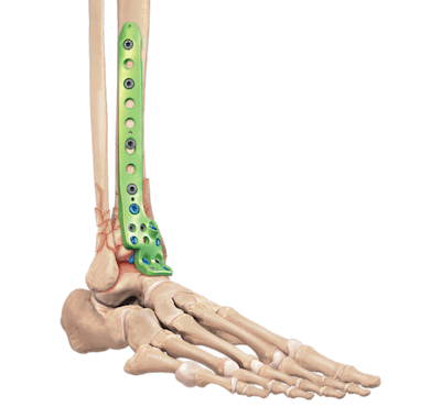 Sistema de placas de fusión para fracturas del pilón