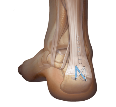 Achilles SpeedBridge™ Repair