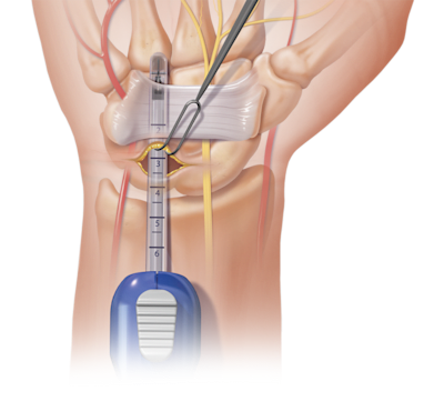 Centerline™ Endoscopic Carpal Tunnel Release Technique