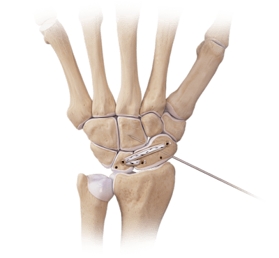 Reparación de ligamento escafolunar con DX SwiveLock<sup>®</sup> SL