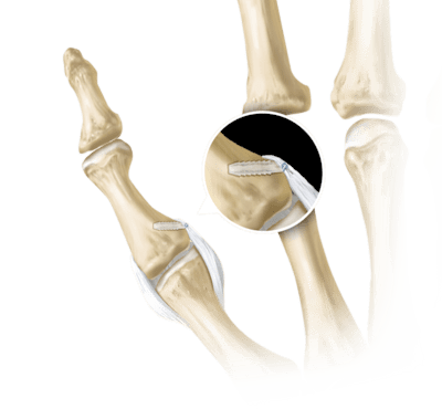 Reparación del ligamento colateral del pulgar con SutureTak<sup>®</sup>
