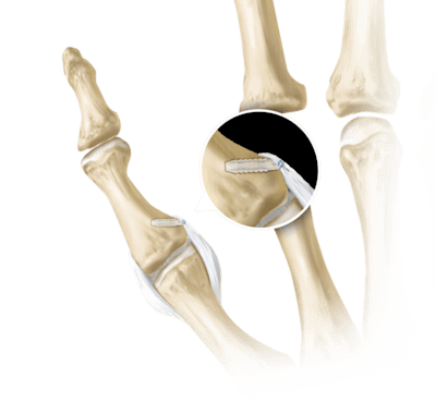 SutureTak<sup>®</sup> Thumb Collateral Ligament Repair