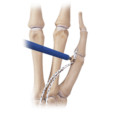 Reconstrução do ligamento colateral do polegar com DX SwiveLock<sup>®</sup> SL