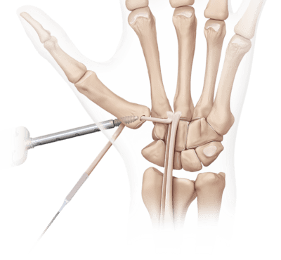 Ligament Reconstruction - Tendon Interposition