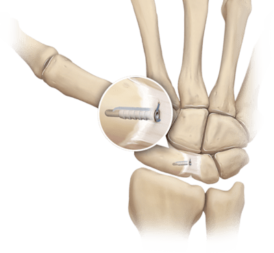 Scapholunate Ligament
 Fixation