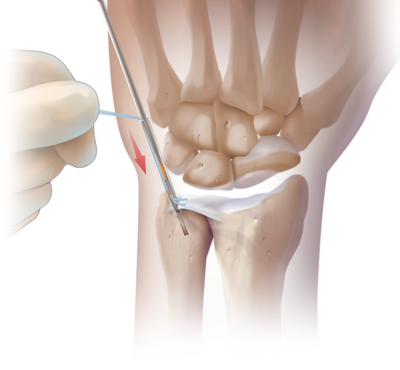 Arthroscopic Knotless TFCC Repair Back to Bone