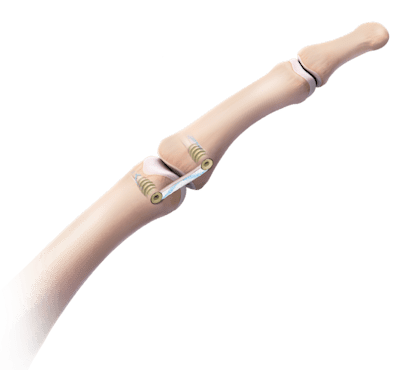 Reconstrucción del ligamento colateral del pulgar con tornillos para Bio-Tenodesis™ de 3 mm x 8 mm