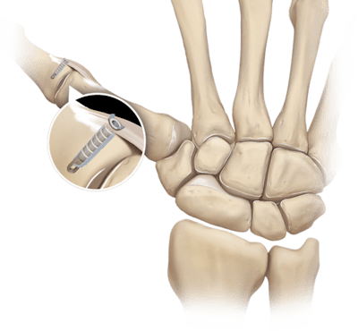 Reparo do ligamento colateral do polegar com PushLock<sup>®</sup> 2,5 mm