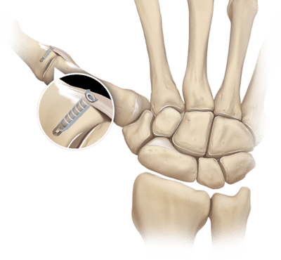 2.5 mm PushLock<sup>®</sup>  Thumb Collateral Ligament Repair