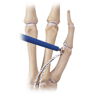 Hand/Wrist <em>Internal</em>Brace™ Ligament Augmentation Repair Convenience Kit