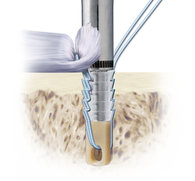 Knotless Suture Anchors