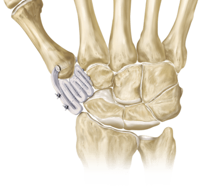 Tenodesis