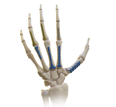Mini Fragment Plates and
Screws