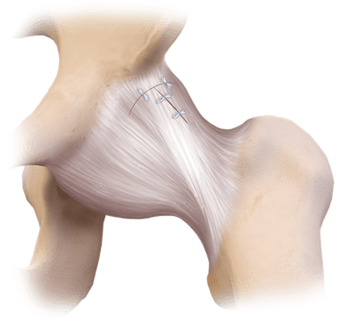 LoopLoc™ Knotless Implant