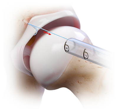 Fijación del labrum