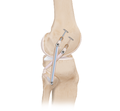 Lateral Collateral Ligament (LCL) and Posterolateral Corner (PLC) Reconstruction 