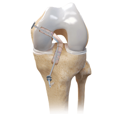 Posterior Cruciate Ligament (PCL) Reconstruction