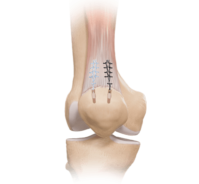 Quadriceps Tendon Repair 