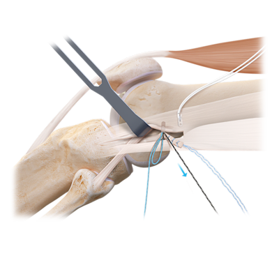 Lateral Extra-Articular Tenodesis