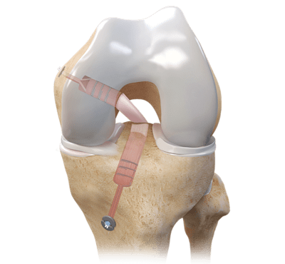 Posterior Cruciate Ligament (PCL) Reconstruction