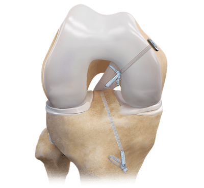 Posterior Cruciate Ligament (PCL) Repair 