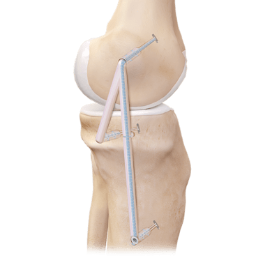 Medial Collateral Ligament (MCL) Reconstruction
