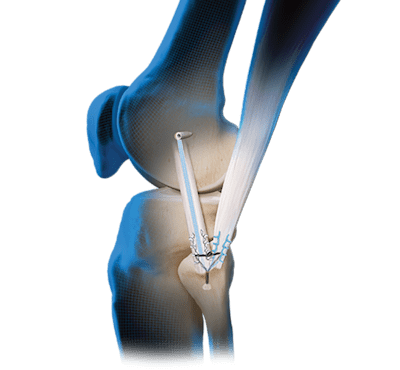 Lateral Collateral Ligament (LCL) and Posterolateral Corner (PLC) Repair